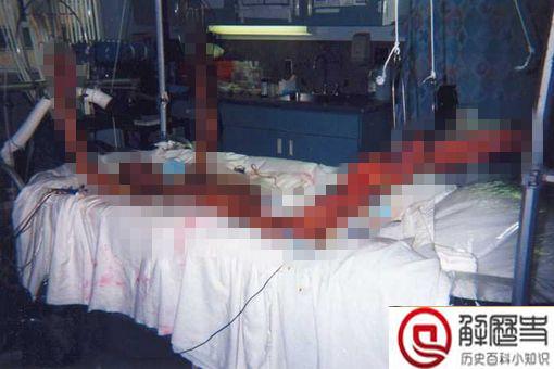 大内久83天活体腐烂是什么 大内久83天活体腐烂图片